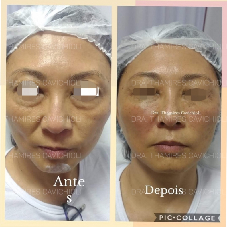 Botox e Preenchimento Facial Cidade Ademar - Preenchimento Rosto