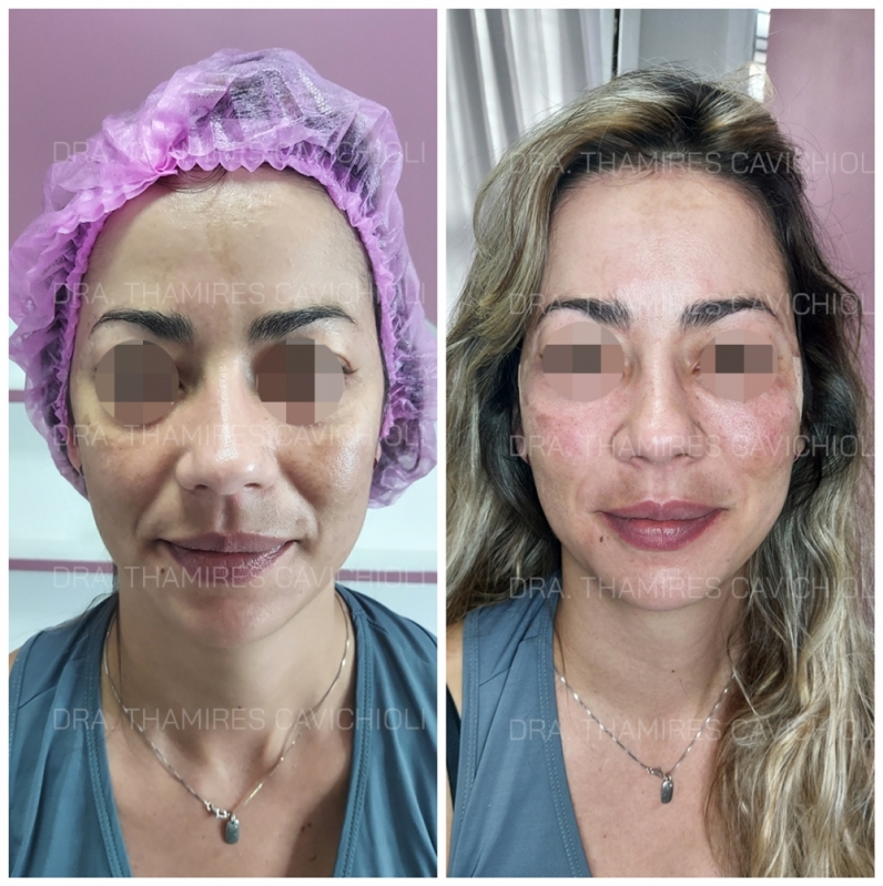 Clínica de Harmonização Facial Mulher Vila Gomes Cardim - Harmonização Facial no Queixo