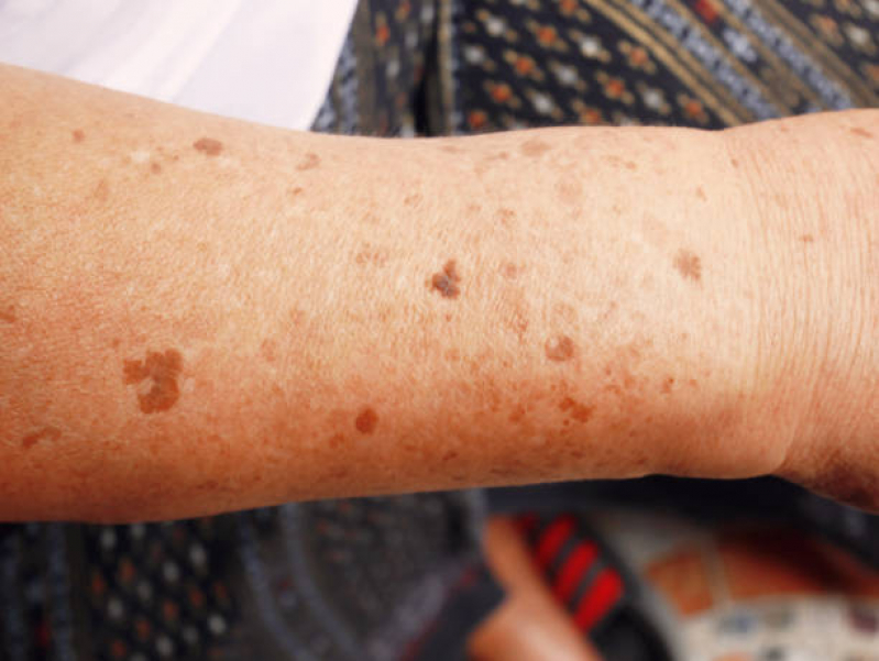 Onde Marcar Tratamento para Manchas da Acne Tatuapé - Tratamento a Laser para Manchas na Pele