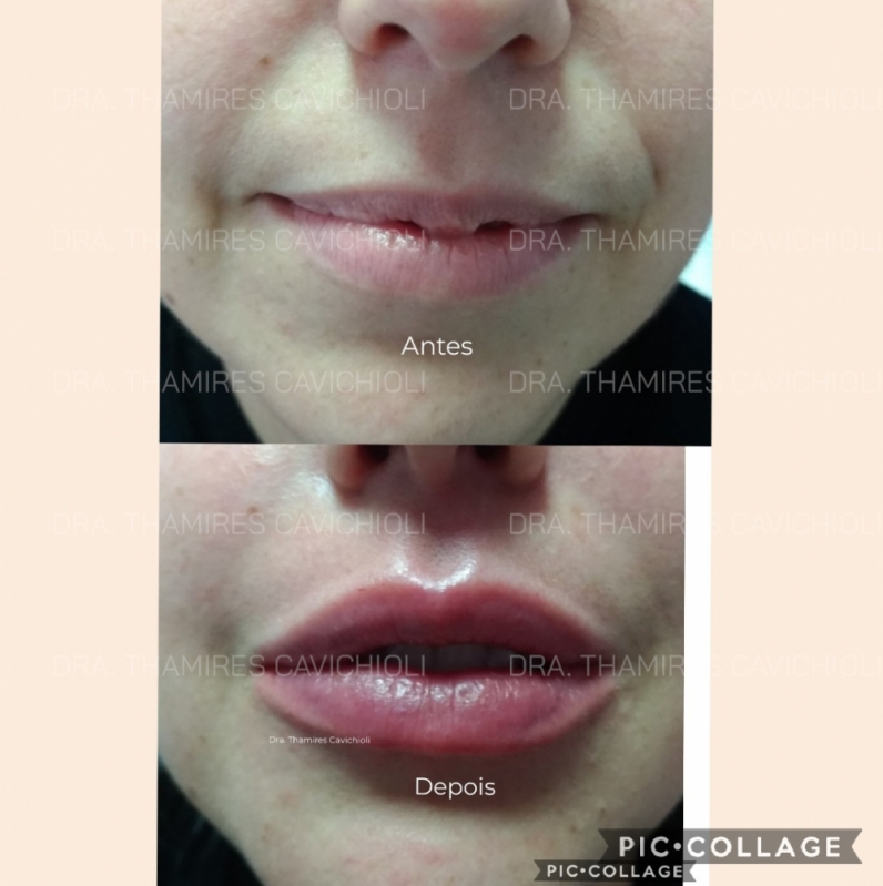 Preenchimento Facial ácido Hialurônico Agendar Poá - Botox e Preenchimento Facial