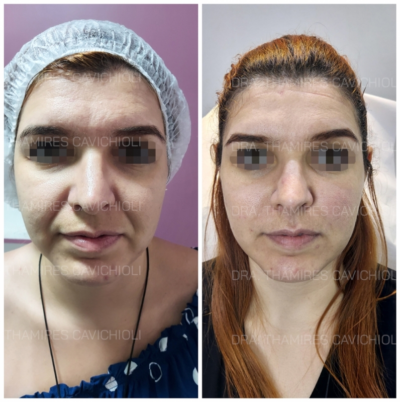 Preenchimento Facial Olheiras Agendar Caieiras - Botox e Preenchimento Facial