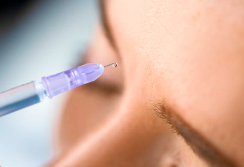 Preenchimentos Faciais ácido Hialurônico Vila Brasil - Botox e Preenchimento Facial