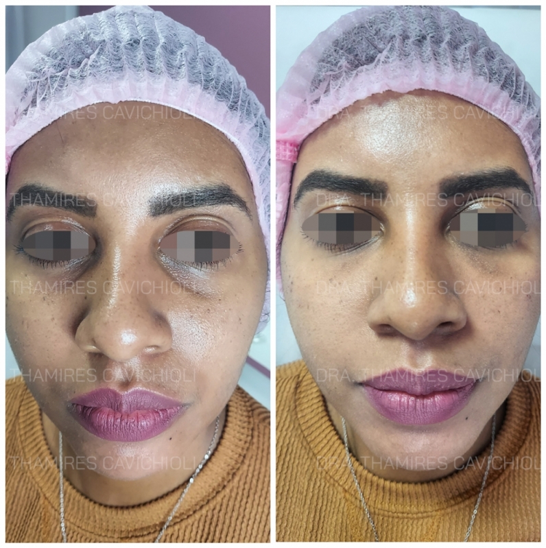 Procedimento de Preenchimento para Rejuvenescimento Facial Cajamar - Preenchimento Facial Nariz