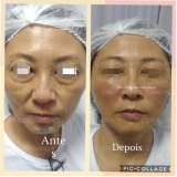 botox e preenchimento facial Zona Norte