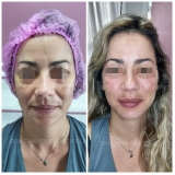 clínica de harmonização facial mulher Diadema