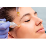preço de tratamento para acne e manchas Diadema