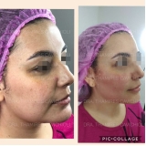 procedimento de harmonização facial Itaim Paulista