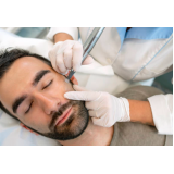 procedimento de microagulhamento no rosto cotação Taboão da Serra