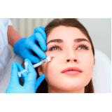 procedimento de preenchimento facial com ácido hialurônico Belém