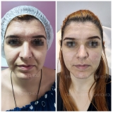 procedimento de preenchimento facial Sé