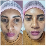 procedimento de preenchimento para rejuvenescimento facial Lapa