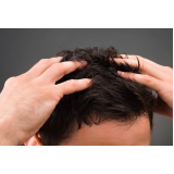 tratamento capilar para queda de cabelo Carapicuíba