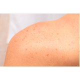 tratamento estetico para manchas de acne Lapa