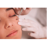 tratamento para acne e manchas clínica Caieiras