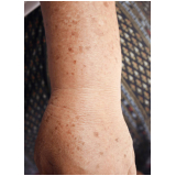 tratamento para manchas da pele Cajamar