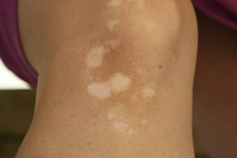 Tratamento a Laser para Manchas na Pele Cursino - Tratamento para Tirar Manchas da Pele