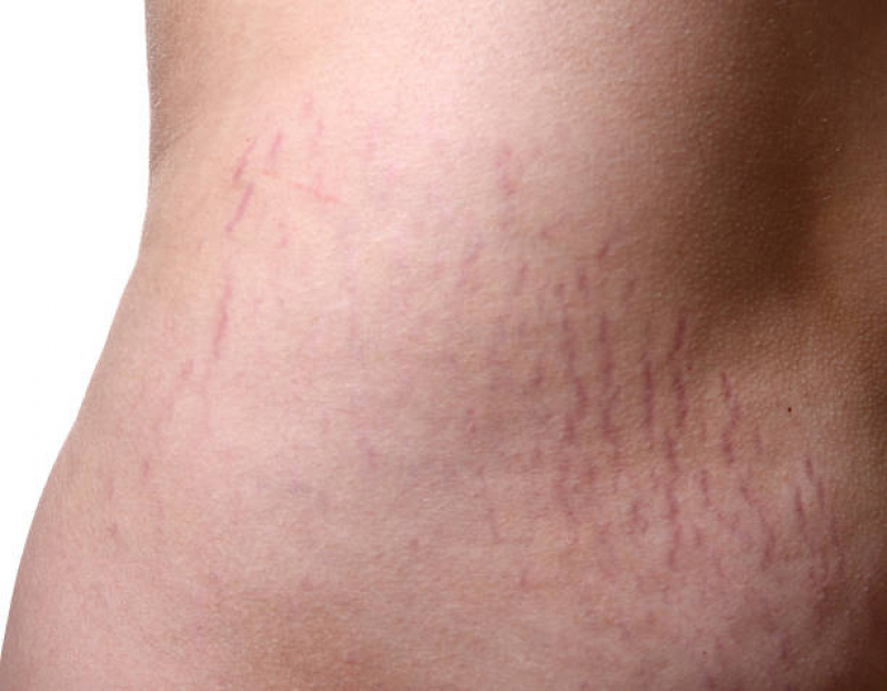 Tratamento de Estrias e Cicatrizes Ponte Rasa - Tratamento de Estrias com Microagulhamento
